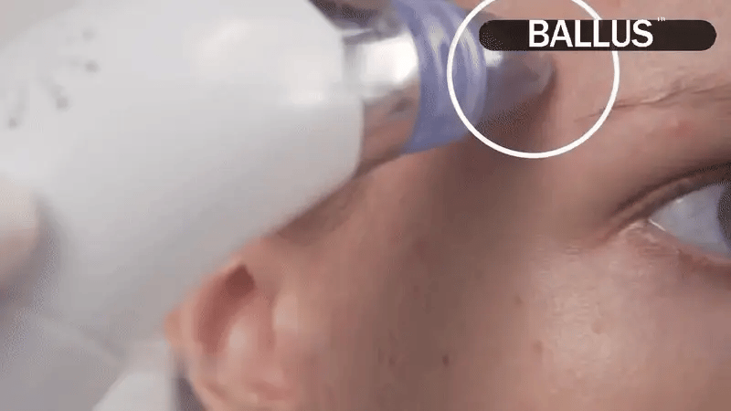 Pore Cleaning Device جهاز تنظيف المسام